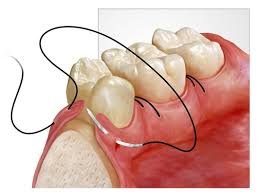 IMAGE FOR ORAL SURGERY IN DENTAL SPA - BEST DENTIST IN PATNA