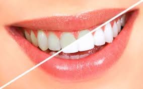 IMAGE USE FOR COSMETIC DENTISTRY IN DENTAL SPA- BEST DENTIST IN PATNA